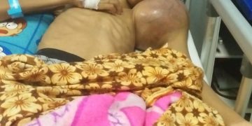 Kholis, Kembali Butuhkan Bantuan Dermawan Untuk Obati Tumor Ganas Yang Muncul Di Tangan Kiri
