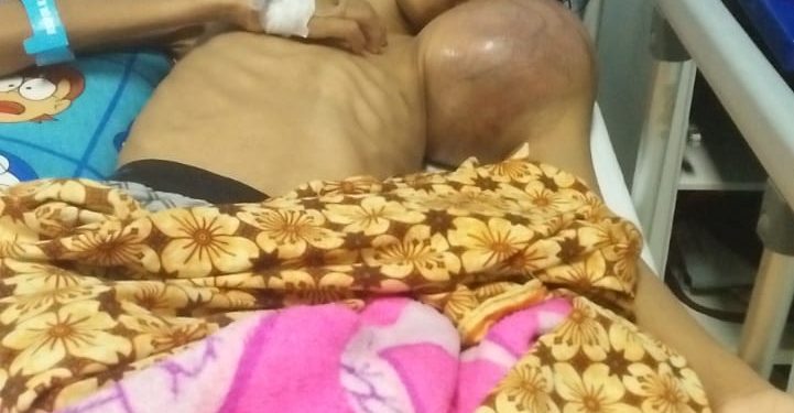Kholis, Kembali Butuhkan Bantuan Dermawan Untuk Obati Tumor Ganas Yang Muncul Di Tangan Kiri